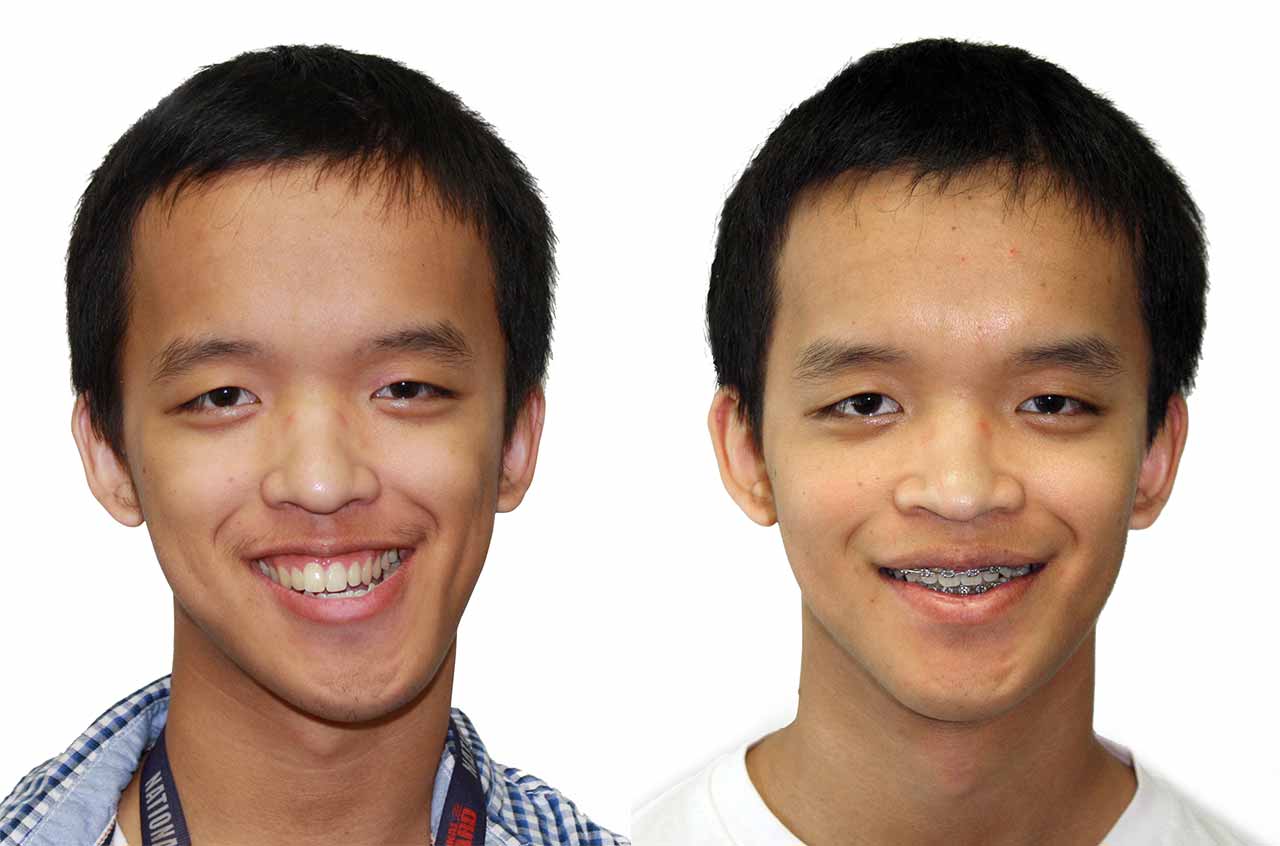 Facial Asymmetry Correction - Orthognathic Surgery