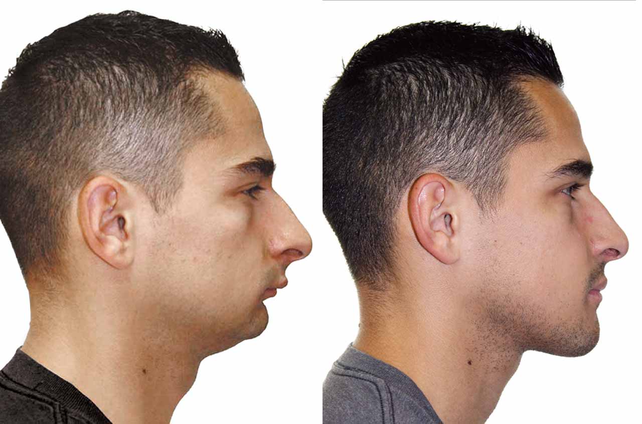 upper-lower-jaw-and-chin-forward-orthognathic-surgery