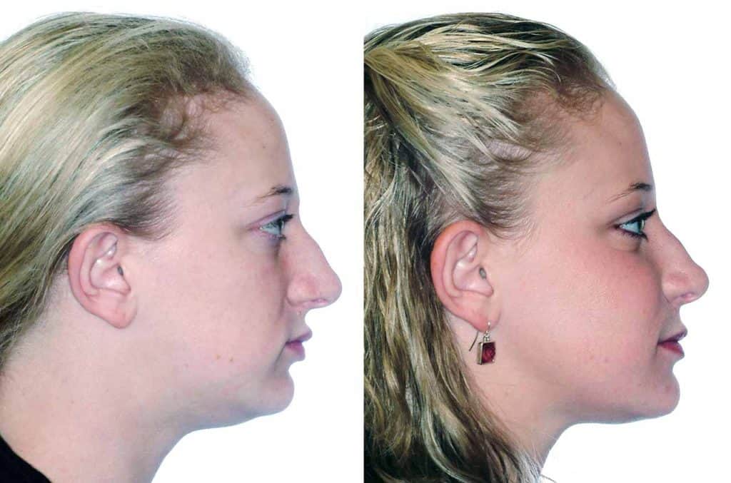 preview@2x cfacefd0 - Orthognathic Surgery