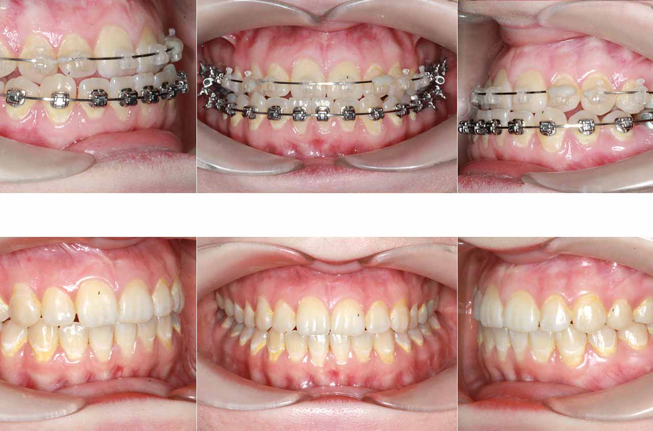 Contouring Of The Mandible Maxillary Advancement And Rhinoplasty