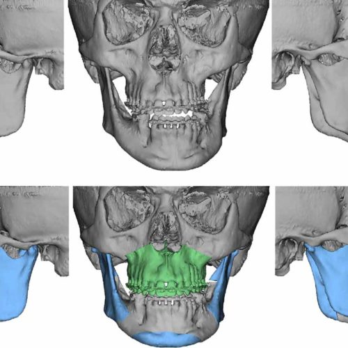 Facial Asymmetry Correction - Orthognathic Surgery