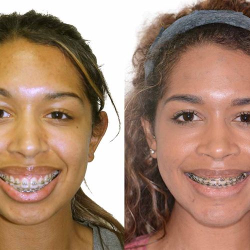 Face, Airway, and Bite Correction - Orthognathic Surgery