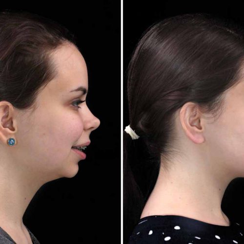 Class Ii Occlusion Anomaly Corrective Jaw Surgery Orthognathic Surgery