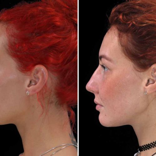 class 2 malocclusion orthognathic surgery