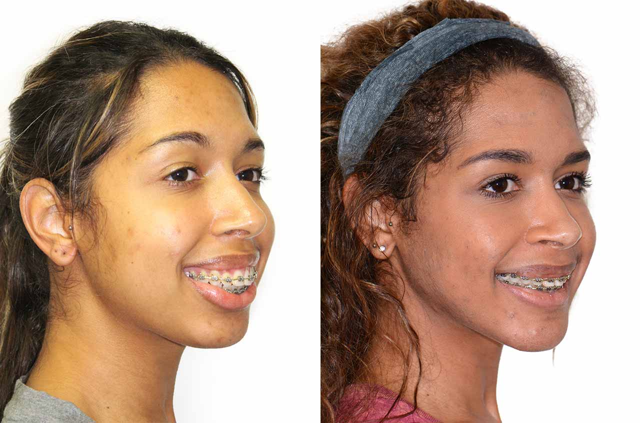 Face Airway And Bite Correction Orthognathic Surgery